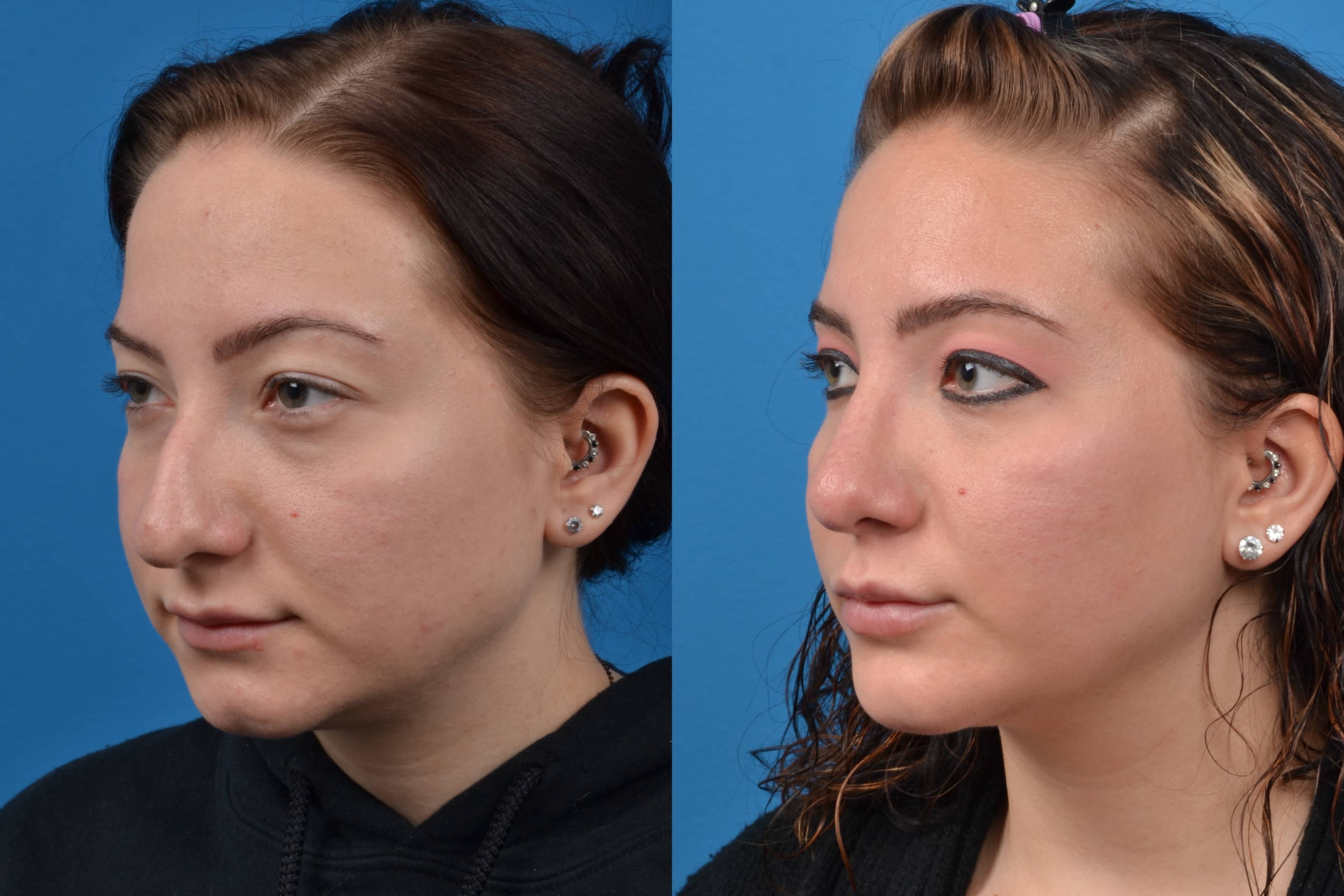 Rhinoplasty Photos Melbourne Fl Patient 14603